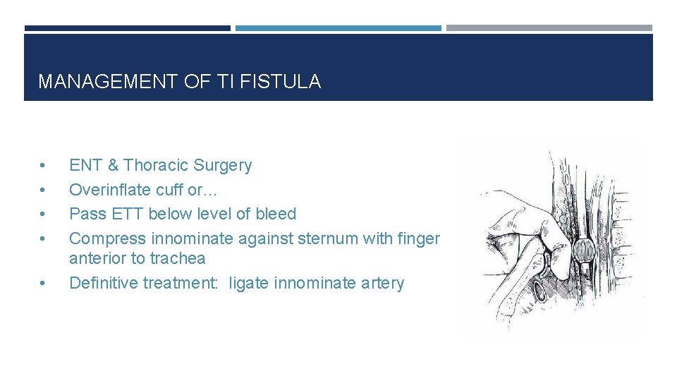 MANAGEMENT OF TI FISTULA • • • ENT & Thoracic Surgery Overinflate cuff or…