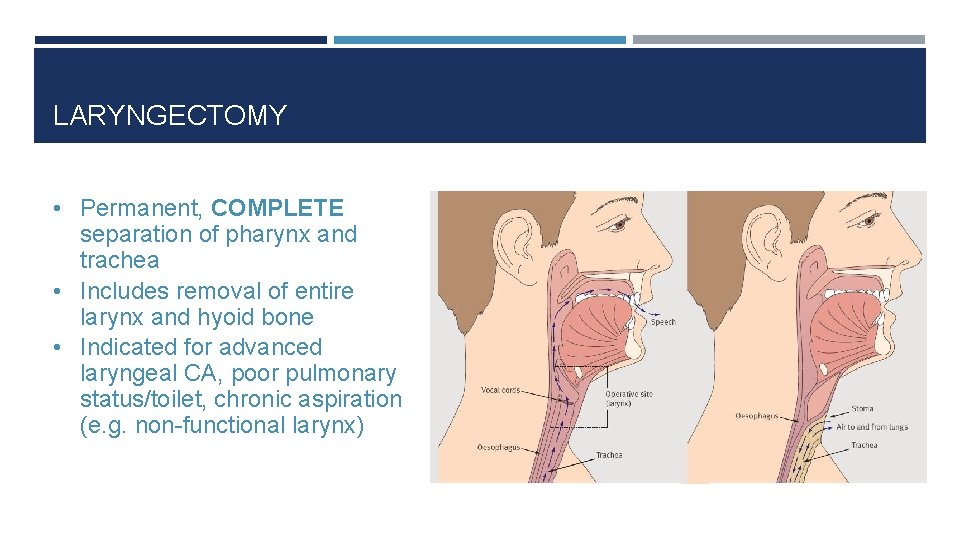 LARYNGECTOMY • Permanent, COMPLETE separation of pharynx and trachea • Includes removal of entire