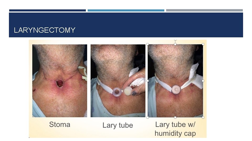 LARYNGECTOMY 