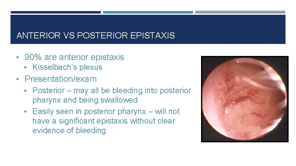 ANTERIOR VS POSTERIOR EPISTAXIS • 90% are anterior epistaxis • Kisselbach’s plexus • Presentation/exam