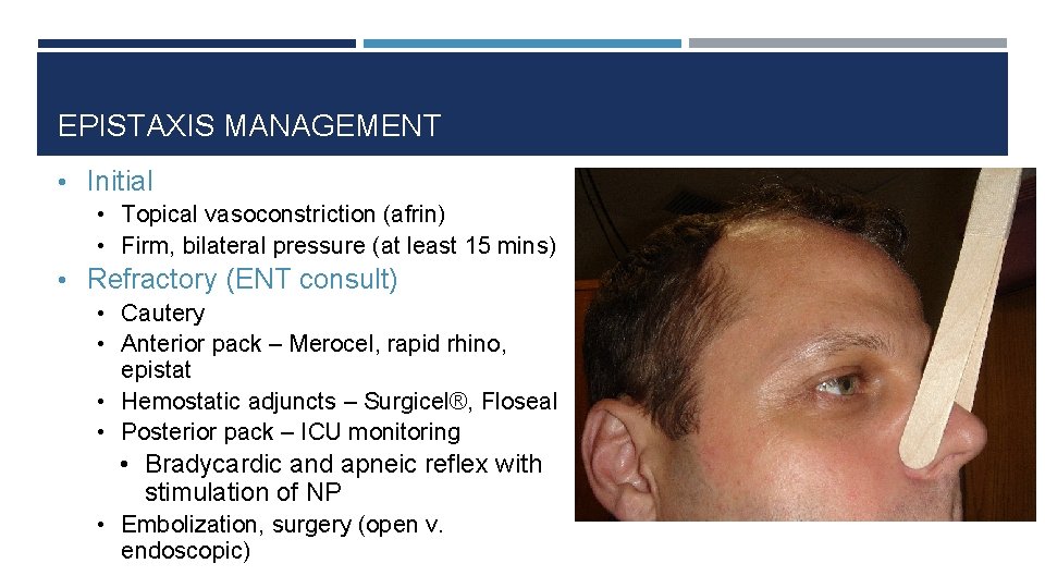 EPISTAXIS MANAGEMENT • Initial • Topical vasoconstriction (afrin) • Firm, bilateral pressure (at least