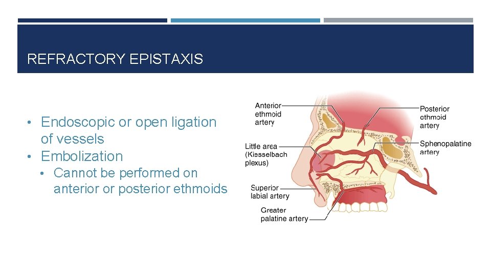 REFRACTORY EPISTAXIS • Endoscopic or open ligation of vessels • Embolization • Cannot be