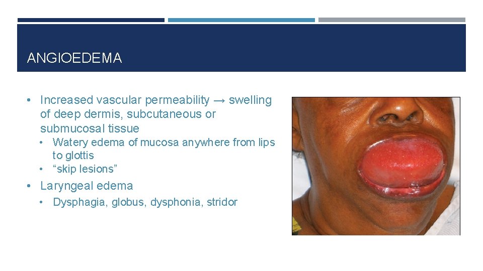 ANGIOEDEMA • Increased vascular permeability → swelling of deep dermis, subcutaneous or submucosal tissue