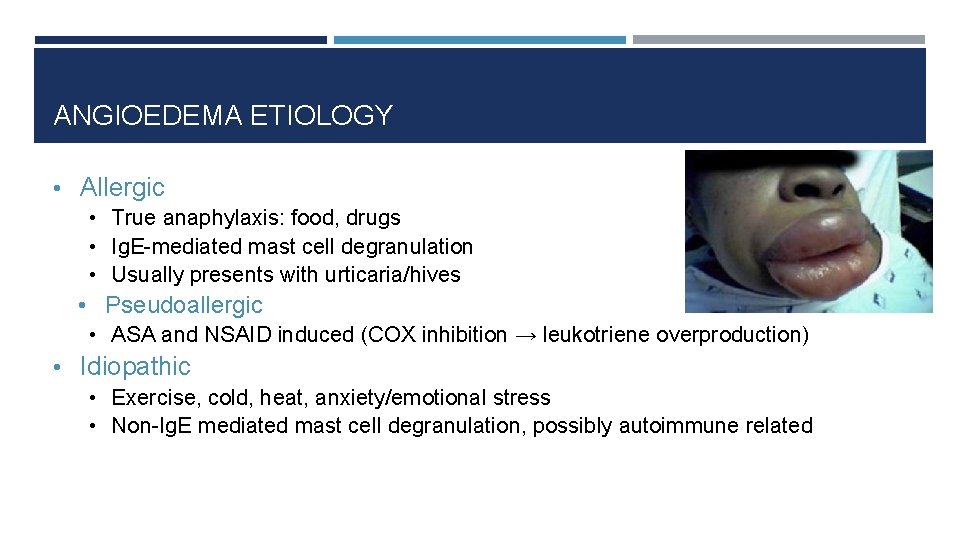 ANGIOEDEMA ETIOLOGY • Allergic • True anaphylaxis: food, drugs • Ig. E-mediated mast cell