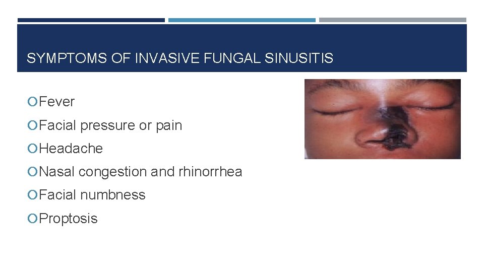 SYMPTOMS OF INVASIVE FUNGAL SINUSITIS Fever Facial pressure or pain Headache Nasal congestion and