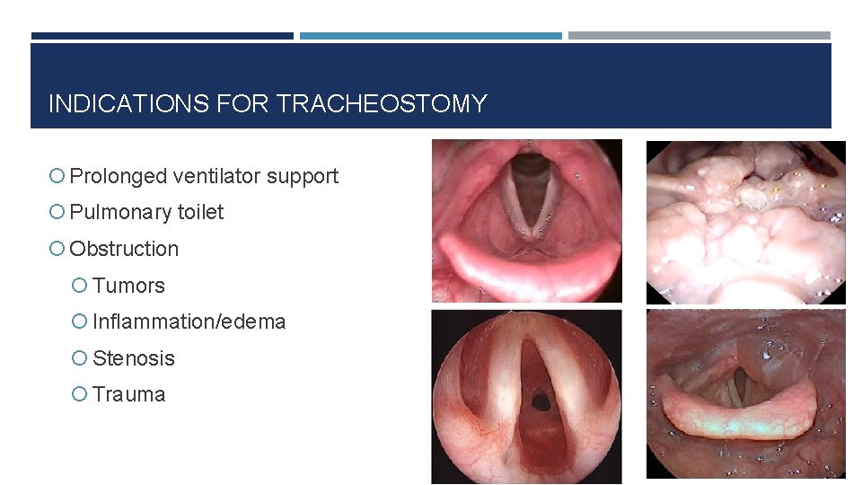 INDICATIONS FOR TRACHEOSTOMY Prolonged ventilator support Pulmonary toilet Obstruction Tumors Inflammation/edema Stenosis Trauma 