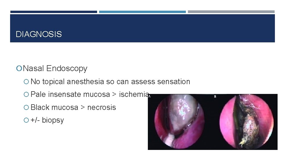 DIAGNOSIS Nasal Endoscopy No topical anesthesia so can assess sensation Pale insensate mucosa >