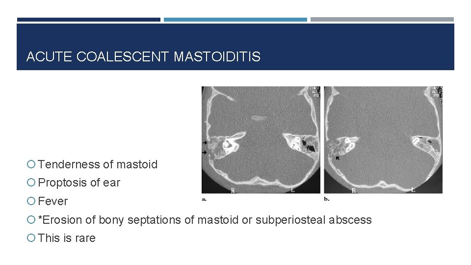 ACUTE COALESCENT MASTOIDITIS Tenderness of mastoid Proptosis of ear Fever *Erosion of bony septations