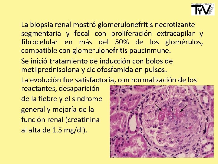 La biopsia renal mostró glomerulonefritis necrotizante segmentaria y focal con proliferación extracapilar y fibrocelular