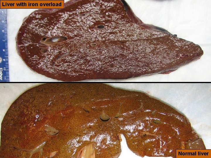 24 Liver with iron overload Version 6, 2010 Normal liver 