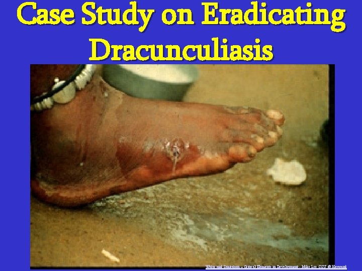 Case Study on Eradicating Dracunculiasis Water and Sanitation – Critical Elements in Development -