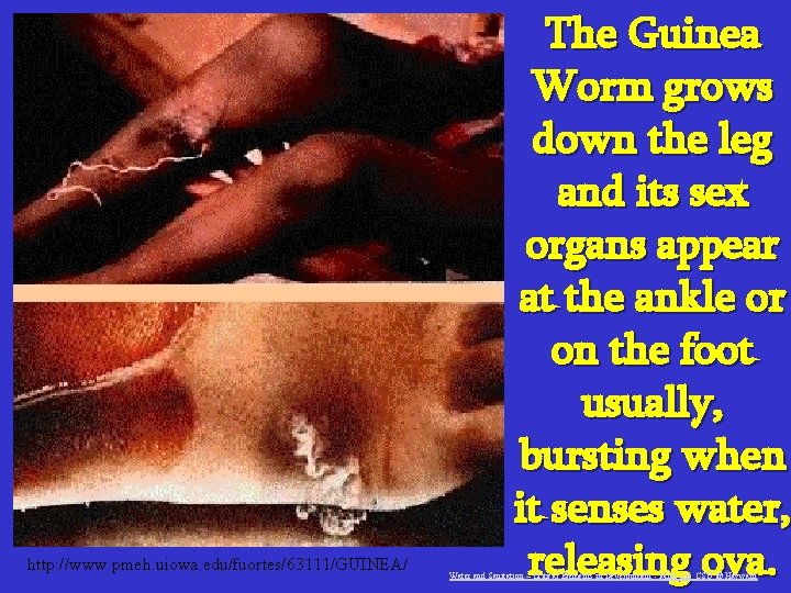 http: //www. pmeh. uiowa. edu/fuortes/63111/GUINEA/ The Guinea Worm grows down the leg and its