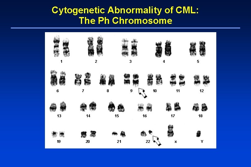 Cytogenetic Abnormality of CML: The Ph Chromosome 1 6 2 7 3 8 13