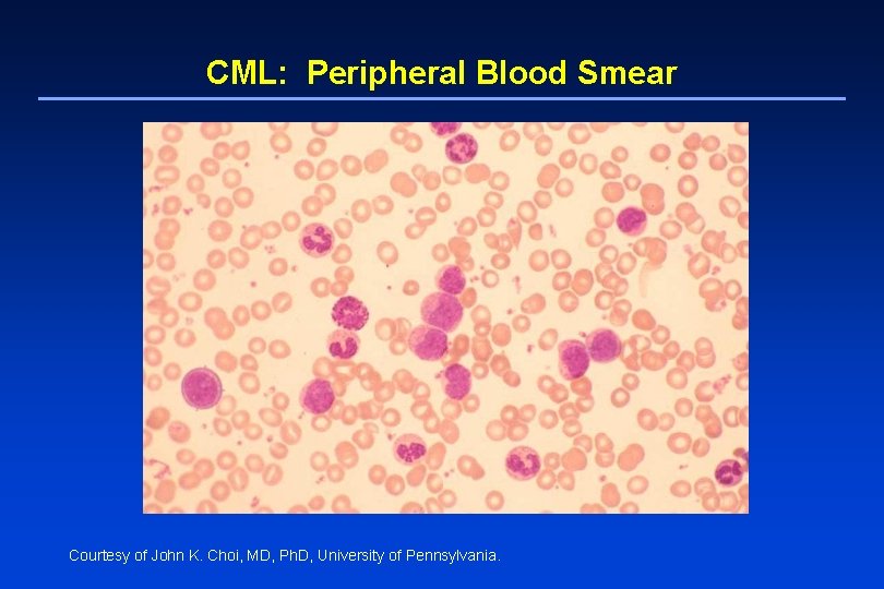 CML: Peripheral Blood Smear Courtesy of John K. Choi, MD, Ph. D, University of