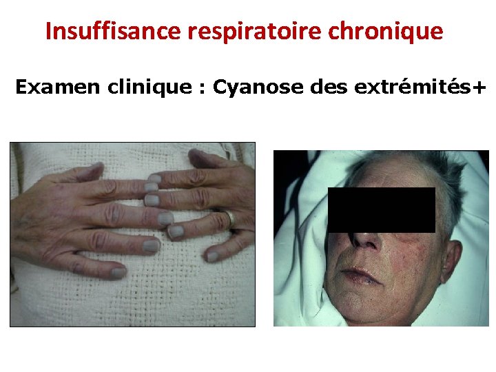Insuffisance respiratoire chronique Examen clinique : Cyanose des extrémités+ 
