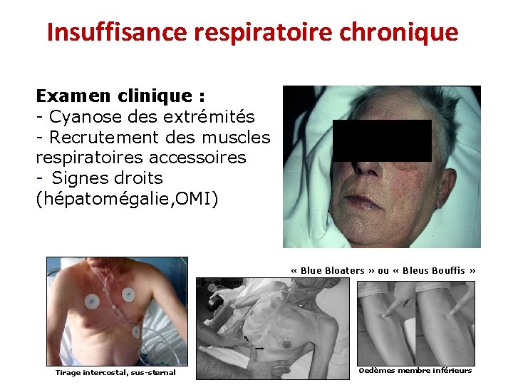 Insuffisance respiratoire chronique Examen clinique : - Cyanose des extrémités - Recrutement des muscles