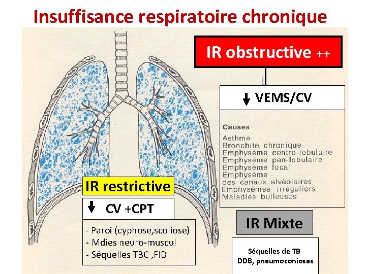 Insuffisance respiratoire chronique IR obstructive ++ VEMS/CV IR restrictive CV +CPT - Paroi (cyphose,