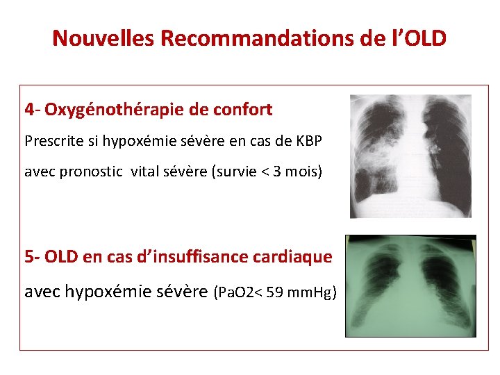 Nouvelles Recommandations de l’OLD 4 - Oxygénothérapie de confort Prescrite si hypoxémie sévère en