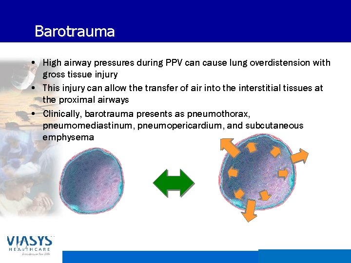 Barotrauma • High airway pressures during PPV can cause lung overdistension with gross tissue