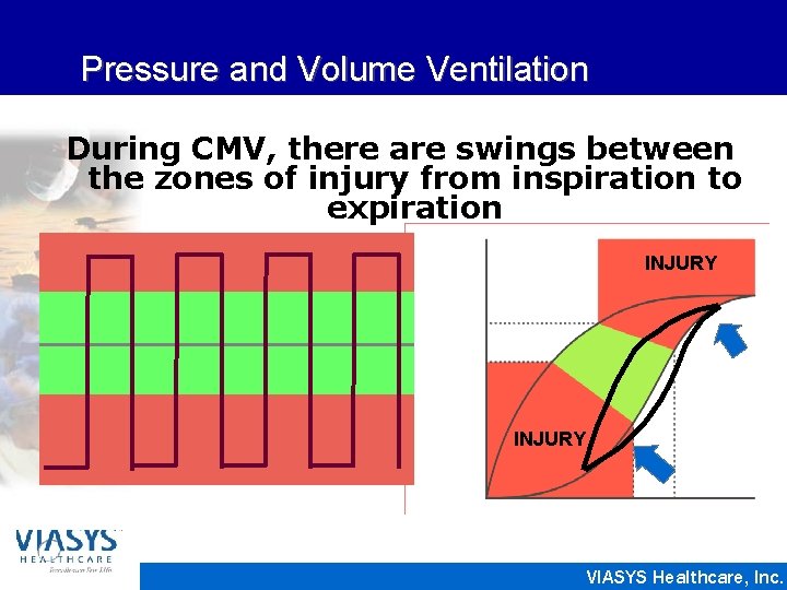 Pressure and Volume Ventilation During CMV, there are swings between the zones of injury