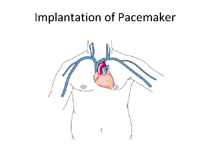 Implantation of Pacemaker 