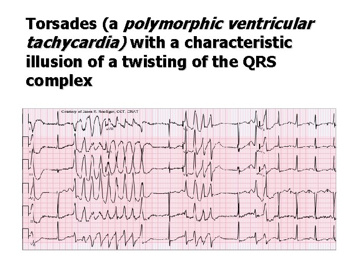 Torsades (a polymorphic ventricular tachycardia) with a characteristic illusion of a twisting of the