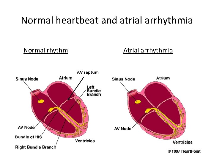 Normal heartbeat and atrial arrhythmia Normal rhythm Atrial arrhythmia AV septum 