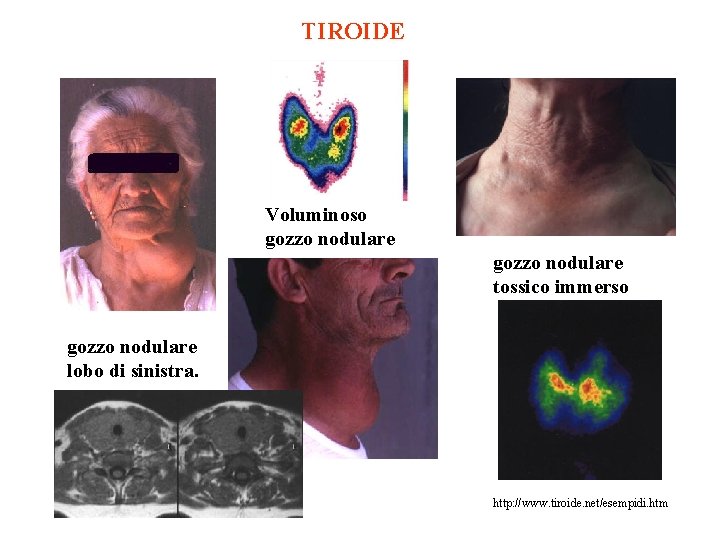 TIROIDE Voluminoso gozzo nodulare tossico immerso gozzo nodulare lobo di sinistra. http: //www. tiroide.