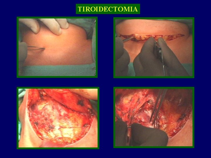 TIROIDECTOMIA TIROIDE 