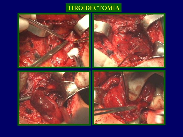 TIROIDECTOMIA TIROIDE 