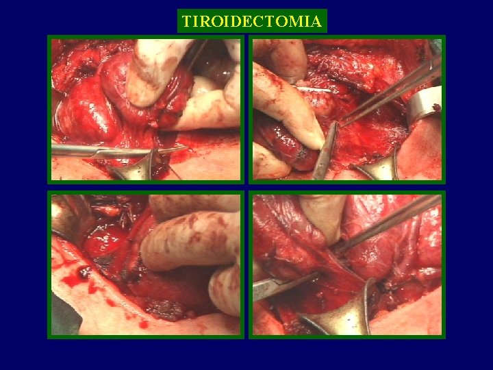TIROIDECTOMIA TIROIDE 