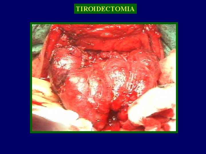 TIROIDECTOMIA TIROIDE 