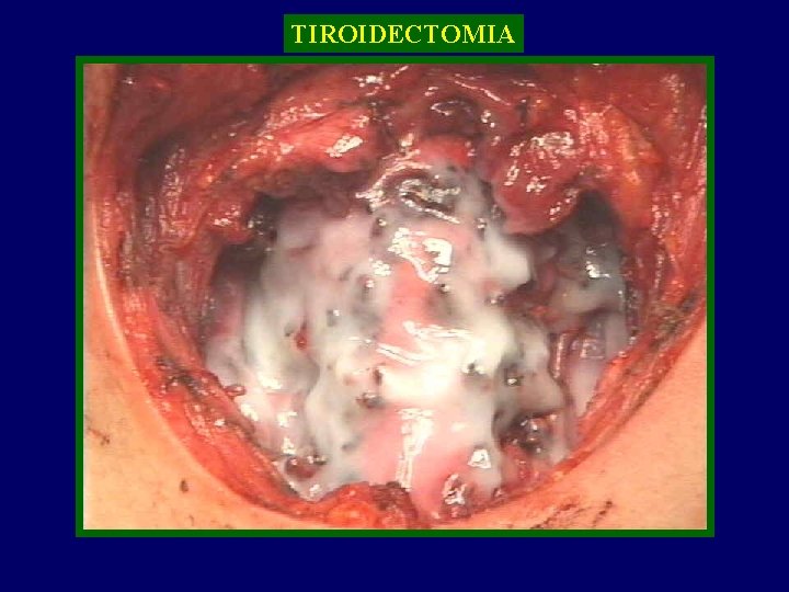 TIROIDECTOMIA TIROIDE 