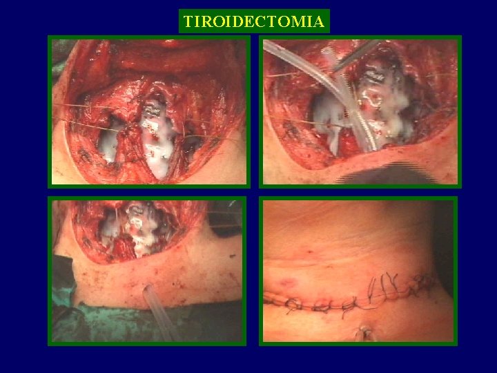 TIROIDECTOMIA TIROIDE 