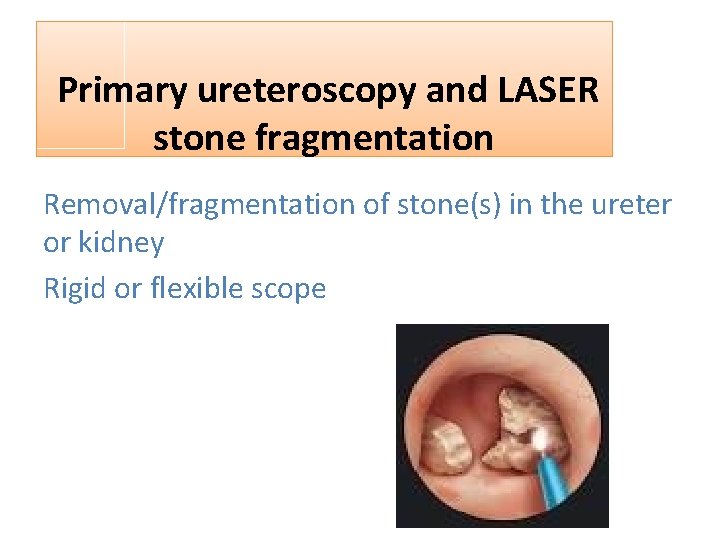  Primary ureteroscopy and LASER stone fragmentation Removal/fragmentation of stone(s) in the ureter or