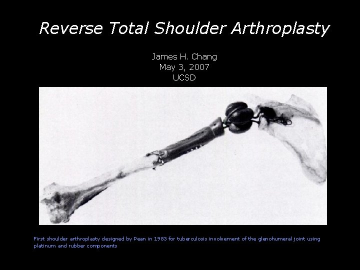 Reverse Total Shoulder Arthroplasty -- First shoulder James H. arthroplasty Chang May 3, 2007