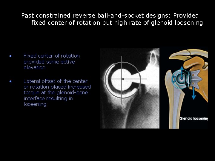 Past constrained reverse shoulder arthroplasty Past constrained reverse ball-and-socket designs: Provided fixed center of