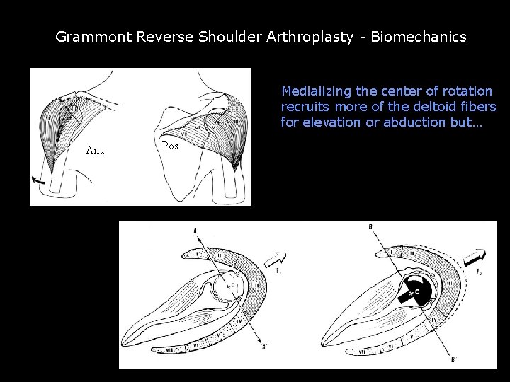 Reverse TSA recruits more deltoid fibers Grammont Reverse Shoulder Arthroplasty - Biomechanics Medializing the