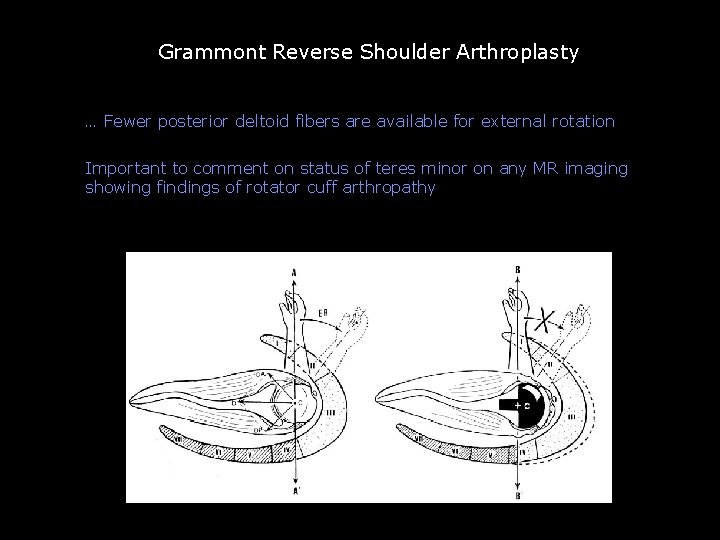 But external rotation is decreased Grammont Reverse Shoulder Arthroplasty … Fewer posterior deltoid fibers