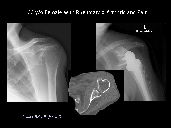60 y/o Female With Rheumatoid Arthritis and Pain Courtesy Tudor Hughes, M. D. 