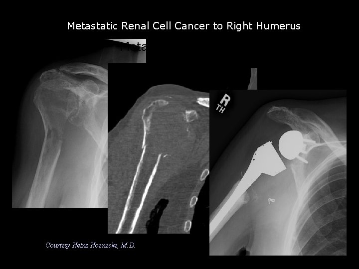 Metastatic Renal Cell Cancer to Right Humerus Metastatic renal cell Courtesy Heinz Hoenecke, M.