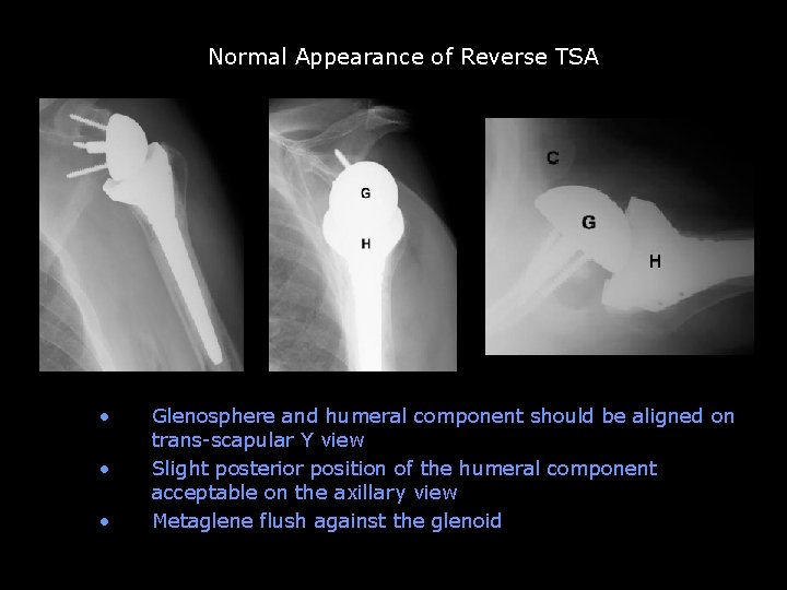 Normal Appearance of Reverse TSA Unconstrained TSA abandoned b/c of glenoid loosening • •