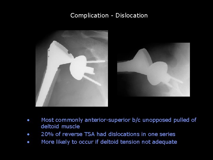 Complication - Dislocation Unconstrained TSA abandoned b/c of glenoid loosening • • • Most