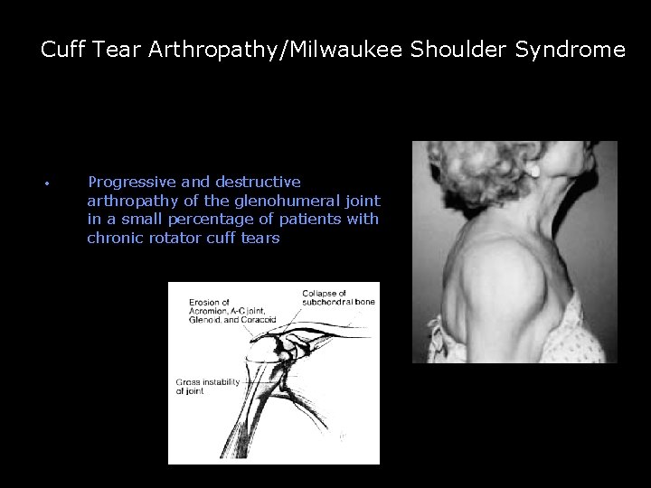 Cuff Tear Arthropathy/Milwaukee Shoulder Syndrome -- • Progressive and destructive arthropathy of the glenohumeral