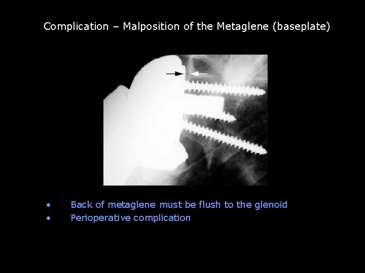 Complication – Malposition of the Metaglene (baseplate) Glenoid baseplate not fully seated • •