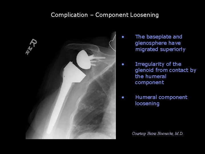 Complication – Component Loosening Component loosening • The baseplate and glenosphere have migrated superiorly