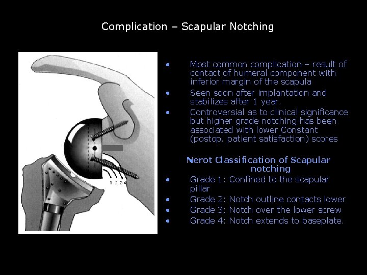 Complication – Scapular Notching • • Most common complication – result of contact of