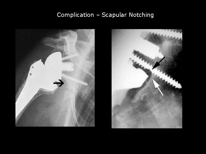 Complication – Scapular Notching 
