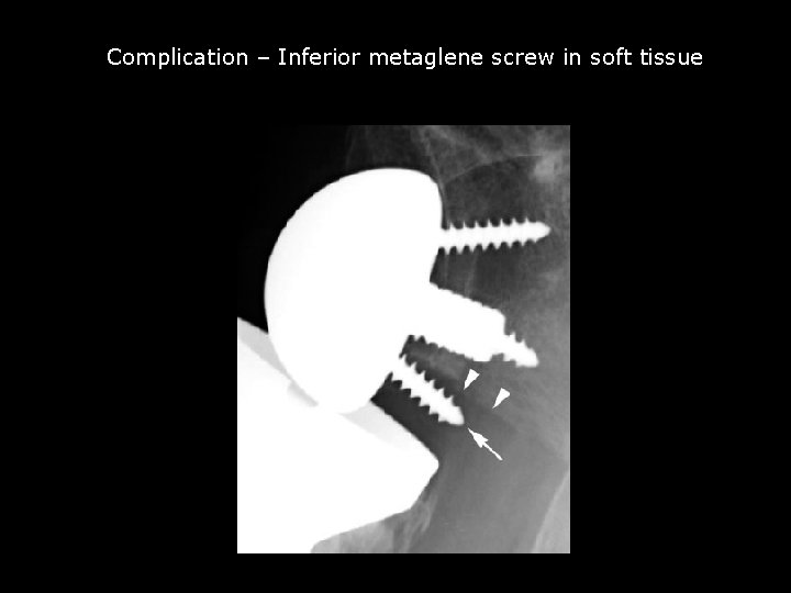 Complication – Inferior metaglene screw in soft tissue Malpositioning of metaglene screw 