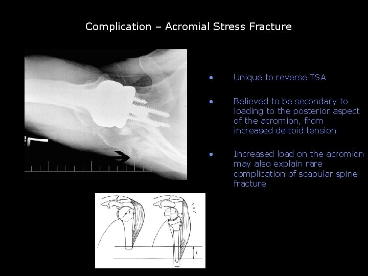 Complication – Acromial Stress Fracture • Unique to reverse TSA • Believed to be